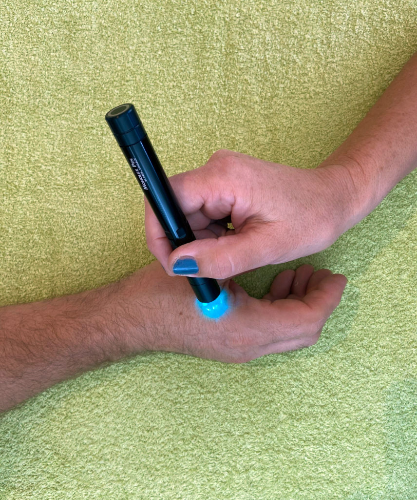 Eciwo-Akupunktur in der Praxis: Behandlung der Hand mit dem Monolux Pen – Therapielicht statt Nadeln